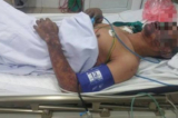 Bệnh nhân T bị nổi ban hoại tử toàn thân, tập trung lớn tại mặt, hai cánh tay và hai chân. (Ảnh: BVCC/qua giadinh.net.vn)