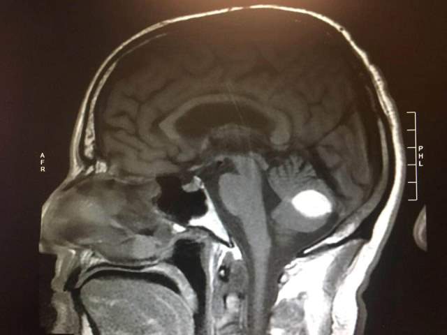 Kỳ tích: Khối u não đột nhiên biến mất trước lúc phẫu thuật