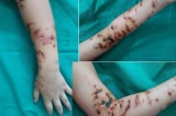 Bé trai 10 tuổi bị loét sâu trên cánh tay do bị sứa đốt
