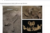 Phát hiện: Hơn 30.000 năm trước, con người đã có thể thực hiện phẫu thuật cắt cụt chi