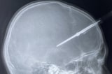Phẫu thuật thành công cho bé trai 12 tuổi bị kéo đâm thủng hộp sọ