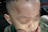 Đà Nẵng: Công an điều tra vụ trẻ nghi bị bạo hành, 2 GV mầm non bị tạm đình chỉ