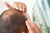 Đường huyết mất kiểm soát có thể gây rụng tóc – 2 cách đẩy lùi chứng hói đầu