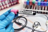 Bộ Y tế đề nghị xác định nguồn lây đậu mùa khỉ