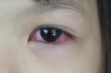 Bến Tre: Hơn 10.500 ca đau mắt đỏ, cảnh báo lan từ trường học sang KCN